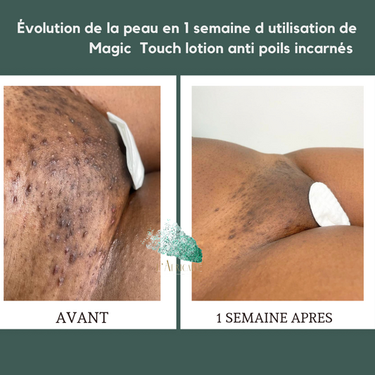 Magic Touch Lotion anti poils incarnés